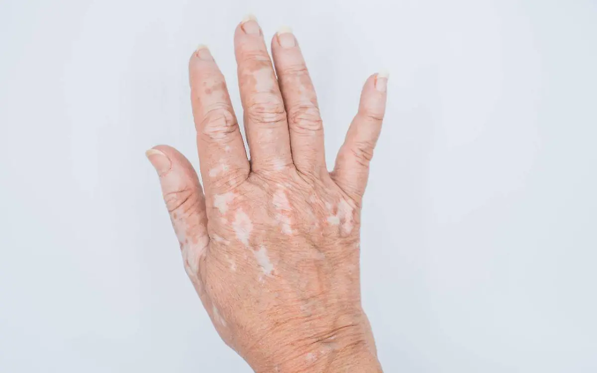 CORTESIA IMSS - VITILIGO 1